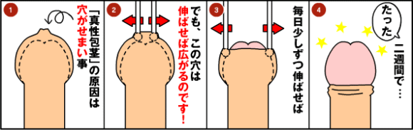 キトー君DX 使用方法は？: キトー君DX 真性包茎矯正器具の口コミ・使用